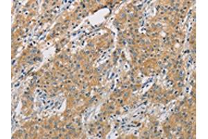 The image on the left is immunohistochemistry of paraffin-embedded Human gastric cancer tissue using ABIN7128504(ARHGEF7 Antibody) at dilution 1/40, on the right is treated with fusion protein. (ARHGEF7 抗体)