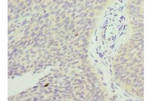 Immunohistochemistry of paraffin-embedded human cervical cancer using ABIN7153251 at dilution of 1:100 (FXYD5 抗体  (AA 22-145))