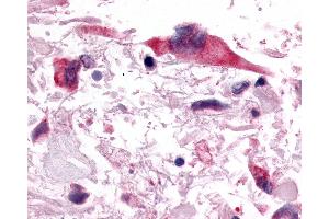 Anti-PGR1 / GPR153 antibody IHC of human Brain, Glioblastoma. (GPR153 抗体  (C-Term))