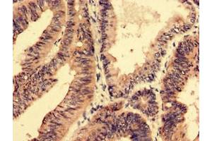 Immunohistochemistry analysis of human colon cancer using ABIN7168686 at dilution of 1:100 (SFRP4 抗体  (AA 293-346))