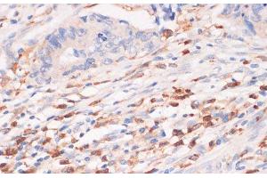 Immunohistochemistry of paraffin-embedded Human colon carcinoma using CYBA Polyclonal Antibody at dilution of 1:100 (40x lens). (CYBA 抗体)