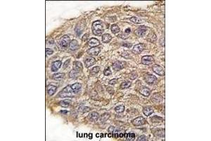 Formalin-fixed and paraffin-embedded human lung carcinoma tissue reacted with ALDOA antibody (N-term) (ABIN389191 and ABIN2839354) , which was peroxidase-conjugated to the secondary antibody, followed by DAB staining. (ALDOA 抗体  (N-Term))