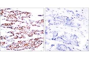 Immunohistochemistry analysis of paraffin-embedded human breast carcinoma, using JunB (Phospho-Ser79) Antibody. (JunB 抗体  (pSer79))