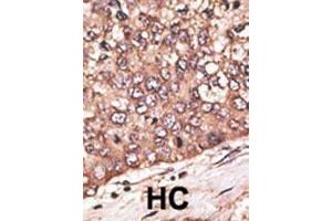 Formalin-fixed and paraffin-embedded human cancer tissue reacted with the primary antibody, which was peroxidase-conjugated to the secondary antibody, followed by DAB staining. (WISP1 抗体  (AA 171-200))
