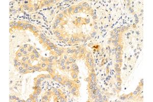ABIN6266055 and ABIN6273350 at 1/100 staining Human lung cancer by IHC-P. (WWP1 抗体  (Internal Region))