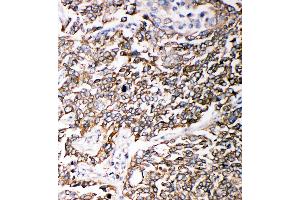 Anti-PMP70 antibody, IHC(P) IHC(P): Human Lung Cancer Tissue (CX3CL1 抗体  (C-Term))