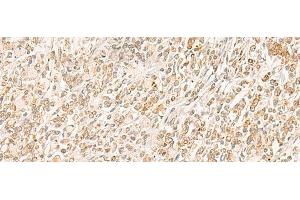 Immunohistochemistry of paraffin-embedded Human gastric cancer tissue using MYCT1 Polyclonal Antibody at dilution of 1:35(x200) (Myc Target 1 抗体)