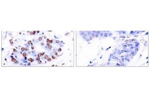 Immunohistochemical analysis of paraffin-embedded human breast carcinoma tissue using NF-κB p65 (Ab-276) antibody (E021011). (NF-kB p65 抗体)