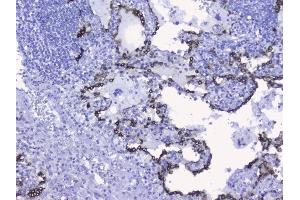 IHC analysis of Cytokeratin 19 using anti-Cytokeratin 19 antibody (ABIN3043288). (Cytokeratin 19 抗体  (C-Term))