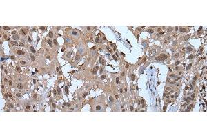 Immunohistochemistry of paraffin-embedded Human esophagus cancer tissue using ZNF787 Polyclonal Antibody at dilution of 1:45(x200) (ZNF787 抗体)