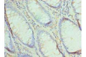 Immunohistochemistry of paraffin-embedded human colon cancer using ABIN7174493 at dilution of 1:100 (UBE2V2 抗体  (AA 1-145))