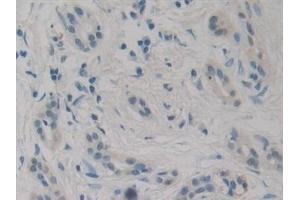 Detection of EBI3 in Human Pancreatic cancer Tissue using Monoclonal Antibody to Epstein Barr Virus Induced Protein 3 (EBI3) (EBI3 抗体  (AA 21-229))