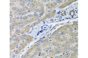 Immunohistochemistry of paraffin-embedded Human liver damage using UGT2B10 Polyclonal Antibody at dilution of 1:100 (40x lens). (UGT2B10 抗体)