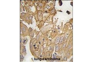 Formalin-fixed and paraffin-embedded human lung carcinoma tissue reacted with GMFG antibody (N-term) (ABIN392351 and ABIN2841990) , which was peroxidase-conjugated to the secondary antibody, followed by DAB staining. (GMFG 抗体  (N-Term))