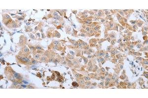 Immunohistochemistry of paraffin-embedded Human lung cancer tissue using FGF1 Polyclonal Antibody at dilution 1:50 (FGF1 抗体)