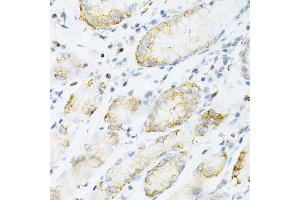 Immunohistochemistry of paraffin-embedded human gastric cancer using SULT2 Antibody (4063) at dilution of 1:200 (40x lens). (SULT2A1 抗体  (AA 1-145))