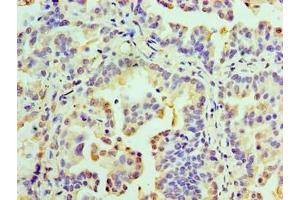 Immunohistochemistry of paraffin-embedded human lung cancer using ABIN7167634 at dilution of 1:100 (RMDN3 抗体  (AA 1-470))