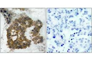 Immunohistochemistry analysis of paraffin-embedded human lung carcinoma, using Akt2 (Phospho-Ser474) Antibody. (AKT2 抗体  (pSer474))