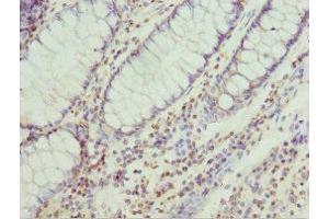 Immunohistochemistry of paraffin-embedded human colon cancer using ABIN7151256 at dilution of 1:100 (TRIM32 抗体  (AA 1-280))