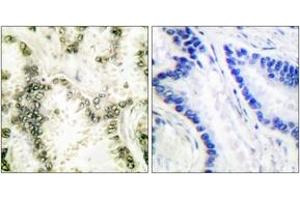 Immunohistochemistry analysis of paraffin-embedded human lung carcinoma tissue, using Ku70 Antibody. (XRCC6 抗体  (AA 560-609))