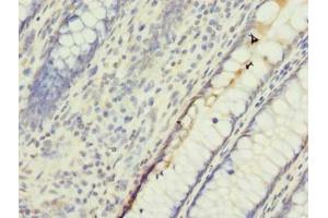 Immunohistochemistry of paraffin-embedded human colon cancer using ABIN7174232 at dilution of 1:100 (UBQLNL 抗体  (AA 305-475))