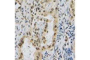 Immunohistochemical analysis of ZNF436 staining in human lung cancer formalin fixed paraffin embedded tissue section. (ZNF436 抗体)