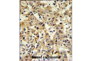 CA6 Antibody IHC analysis in formalin fixed and paraffin embedded breast carcinoma followed by peroxidase conjugation of the secondary antibody and DAB staining. (CA6 抗体  (C-Term))