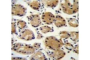 FAT10 antibody immunohistochemistry analysis in formalin fixed and paraffin embedded human stomach carcinoma. (UBD 抗体  (AA 120-153))