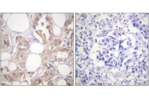Immunohistochemistry analysis of paraffin-embedded human breast carcinoma, using CDK7 (Phospho-Thr170) Antibody. (CDK7 抗体  (pThr170))