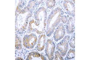 Immunohistochemical analysis of Cytokeratin 18 (pS33) staining in human colon cancer formalin fixed paraffin embedded tissue section. (Cytokeratin 18 抗体  (N-Term, pSer33))