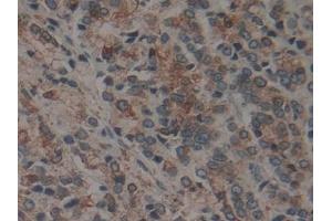 Detection of CNX in Human Prostate cancer Tissue using Polyclonal Antibody to Calnexin (CNX) (Calnexin 抗体  (AA 239-461))