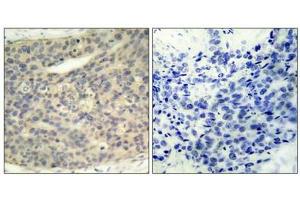 Immunohistochemical analysis of paraffin-embedded human breast carcinoma tissue using LIMK1(Phospho-Thr508) Antibody(left) or the same antibody preincubated with blocking peptide(right). (LIM Domain Kinase 1 抗体  (pThr508))