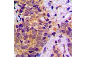 Immunohistochemical analysis of B-RAF staining in human prostate cancer formalin fixed paraffin embedded tissue section. (SNRPE 抗体  (C-Term))