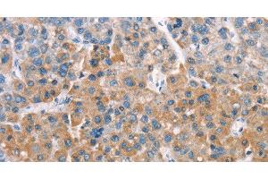 Immunohistochemistry of paraffin-embedded Human liver cancer tissue using LATS2 Polyclonal Antibody at dilution 1:30 (LATS2 抗体)