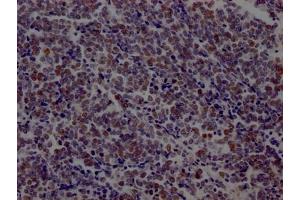 IHC image of ABIN7127456 diluted at 1:100 and staining in paraffin-embedded human lung cancer performed on a Leica BondTM system. (Recombinant LIG1 抗体)