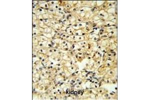 TR Antibody (C-term) 6545b IHC analysis in formalin fixed and paraffin embedded kidney carcinoma followed by peroxidase conjugation of the secondary antibody and DAB staining. (CD40 Ligand 抗体  (C-Term))