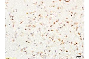 Formalin-fixed and paraffin embedded human lung cancer labeled with Rabbit Anti-MGMT Polyclonal Antibody, Unconjugated  at 1:200 followed by conjugation to the secondary antibody and DAB staining (MGMT 抗体  (AA 101-207))