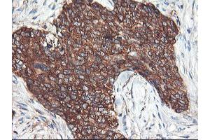 Immunohistochemical staining of paraffin-embedded Adenocarcinoma of Human breast tissue using anti-PFKP mouse monoclonal antibody. (PFKP 抗体)