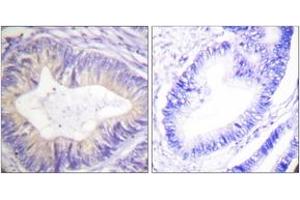 Immunohistochemistry analysis of paraffin-embedded human colon carcinoma tissue, using CBL (Ab-774) Antibody. (CBL 抗体  (AA 740-789))