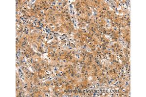 Immunohistochemistry of Human gastric cancer using DNM2 Polyclonal Antibody at dilution of 1:40 (DNM2 抗体)