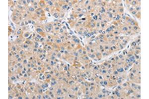 The image on the left is immunohistochemistry of paraffin-embedded Human liver cancer tissue using ABIN7128506(ARHGEF9 Antibody) at dilution 1/50, on the right is treated with fusion protein. (Arhgef9 抗体)