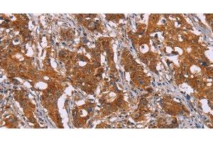 Immunohistochemistry of paraffin-embedded Human gasrtic cancer tissue using DCTN6 Polyclonal Antibody at dilution 1:40 (DCTN6 抗体)