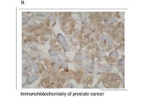 Immunohistochemistry staining of prostate cancer tissue using CYP3A7 antibody. (CYP3A7 抗体  (C-Term))