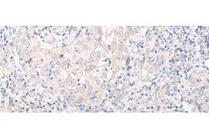 Immunohistochemistry of paraffin-embedded Human cervical cancer tissue using SLC25A27 Polyclonal Antibody at dilution of 1:30(x200) (SLC25A27 抗体)