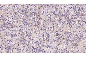 ABIN6273083 at 1/100 staining Human lymph cancer tissue by IHC-P. (TOMM40 抗体  (Internal Region))