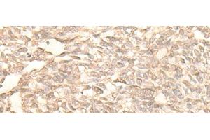 Immunohistochemistry of paraffin-embedded Human lung cancer tissue using RAD23B Polyclonal Antibody at dilution of 1:25(x200) (RAD23B 抗体)