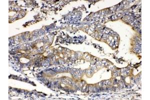 IHC testing of FFPE human intestinal cancer tissue with Calpain 2 antibody at 1ug/ml. (Calpain 2 抗体)