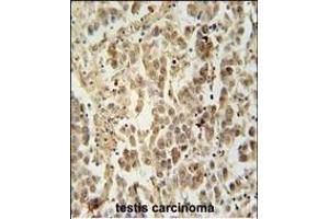 LUZP4 Antibody (N-term) (ABIN654223 and ABIN2844059) immunohistochemistry analysis in formalin fixed and paraffin embedded human testis carcinoma followed by peroxidase conjugation of the secondary antibody and DAB staining. (LUZP4 抗体  (N-Term))