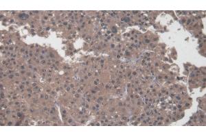 Detection of COL1a2 in Human Liver cancer Tissue using Polyclonal Antibody to Collagen Type I Alpha 2 (COL1a2) (COL1A2 抗体  (AA 1103-1366))