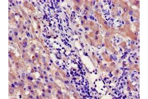Immunohistochemistry of paraffin-embedded human liver cancer using ABIN7142182 at dilution of 1:100 (CYP39A1 抗体  (AA 235-392))